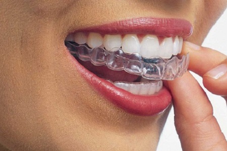 Orthodontie invible de Sparks, spécialité du cabinet Chassaing à Malakoff