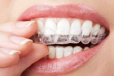 Aligneur orthodontie invisible