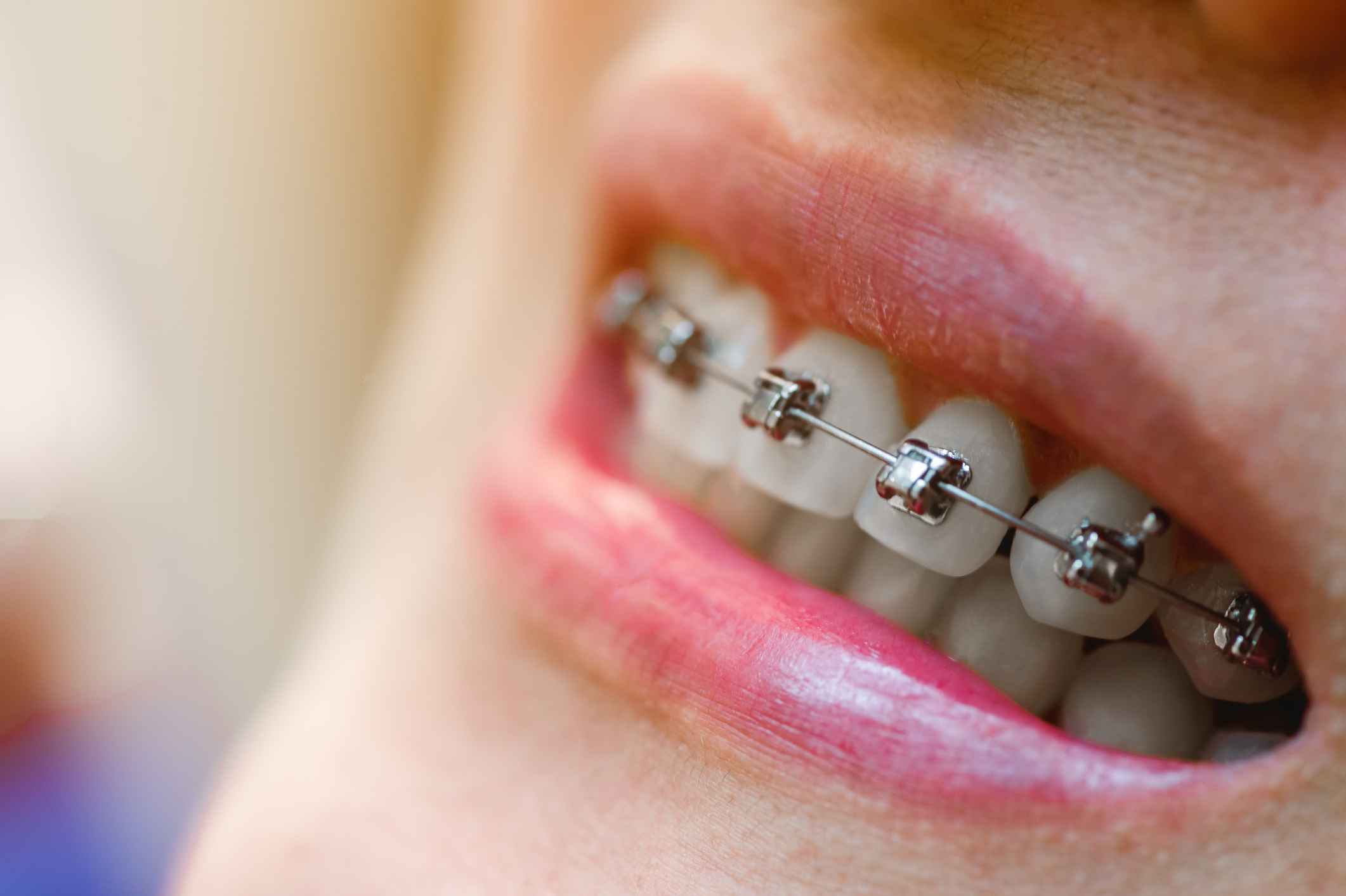 Othodontie auto-ligaturante métal - orthodontie innovante