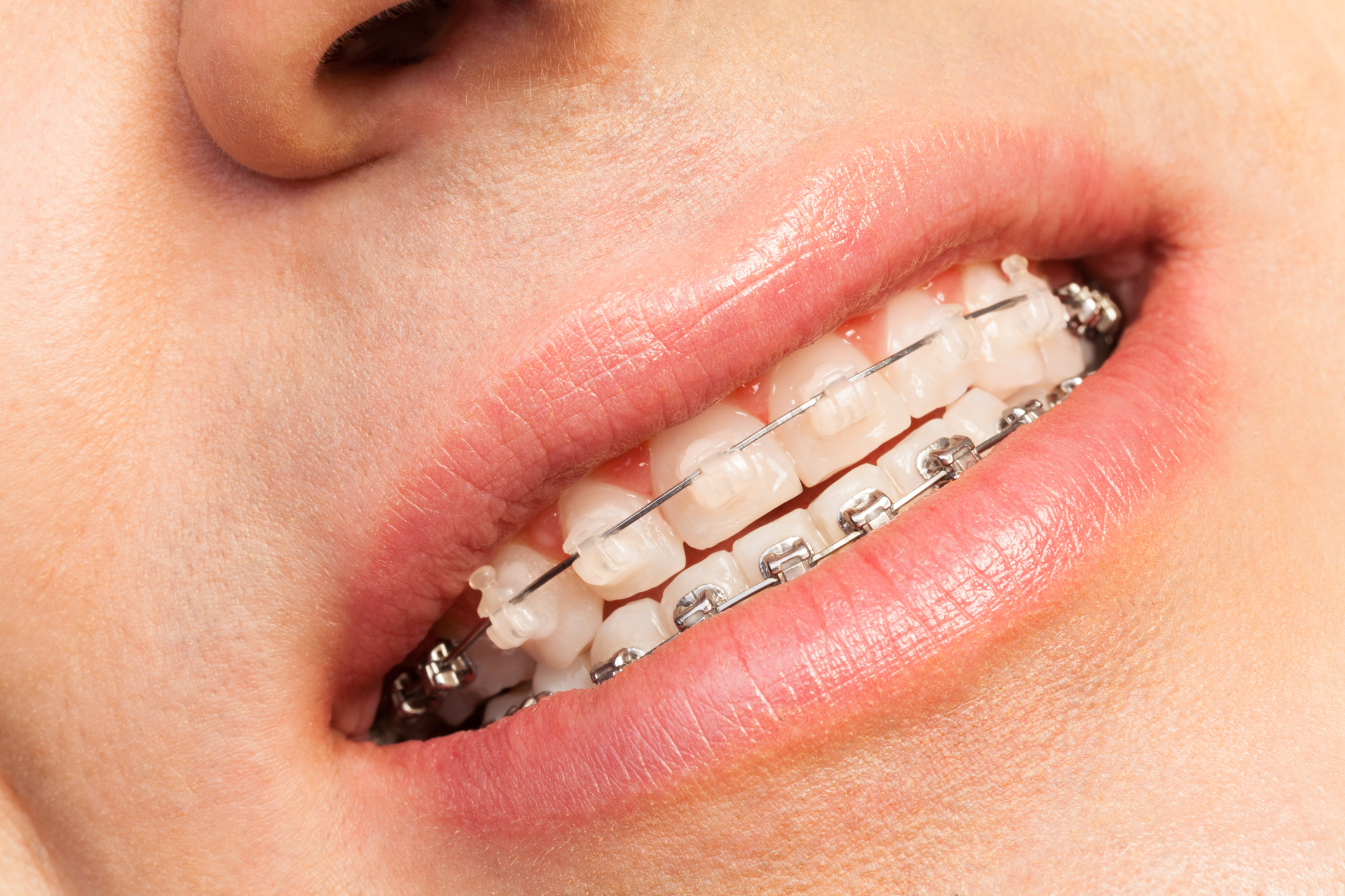 Orthodontie autoligaturante - Docteur Isabelle Chassaing